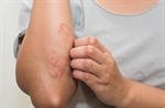 Top 3 Ways to Treat Eczema